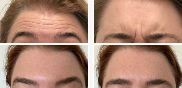 Smoothen those lines for a more youthful appearance