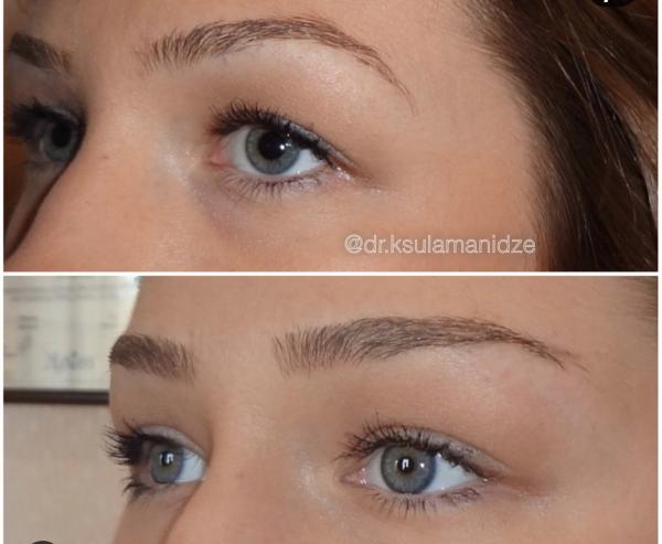 APTOS eyebrow lift is the non-surgical soft eye opener