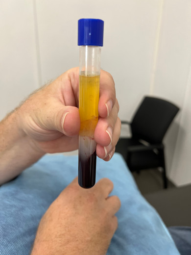 Platelet Rich Plasma activates your natural healing properties and can be directly injected and combined with skin needling for greater effect