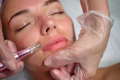 Skin Needling stimulates collagen formation through micro channels in your skin